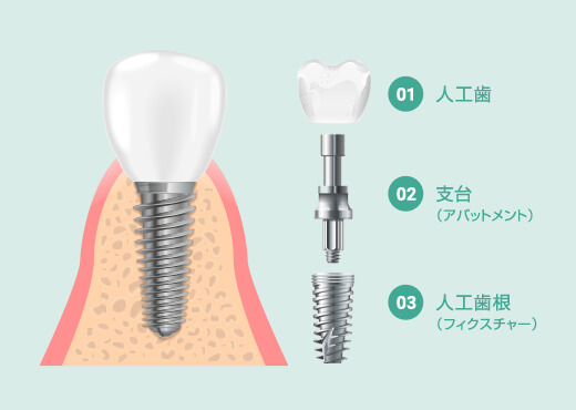 インプラントの構造