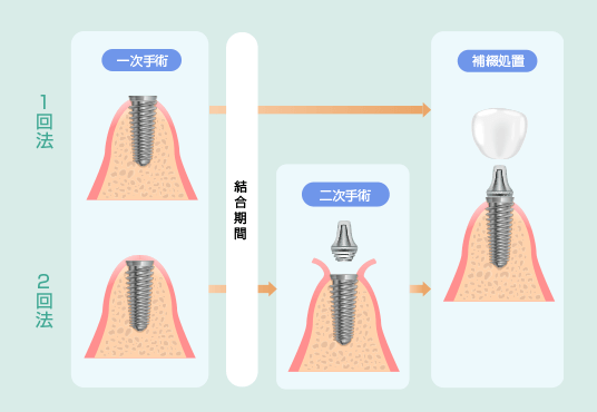 インプラントの手術方法