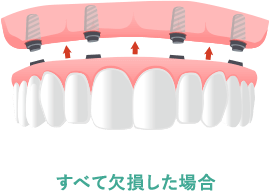 すべて欠損した場合